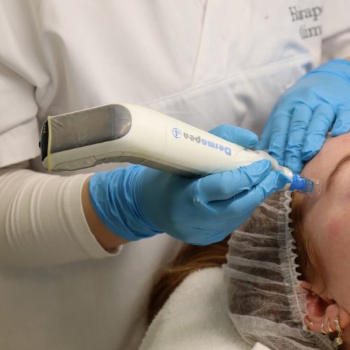 Microneedling met Dermapen voor verbetering van huidstructuur bij Dermanova Clinic