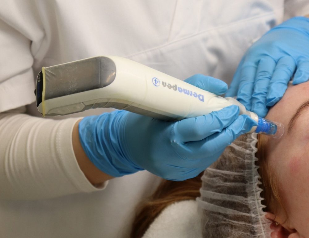 Dermapen Microneedling met Dermapen voor verbetering van huidstructuur bij Dermanova Clinic