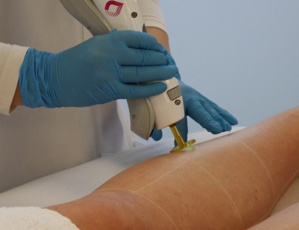 Laserbehandeling Klant ontvangt laserbehandeling met Gentle Max Pro Plus bij Dermanova Clinic