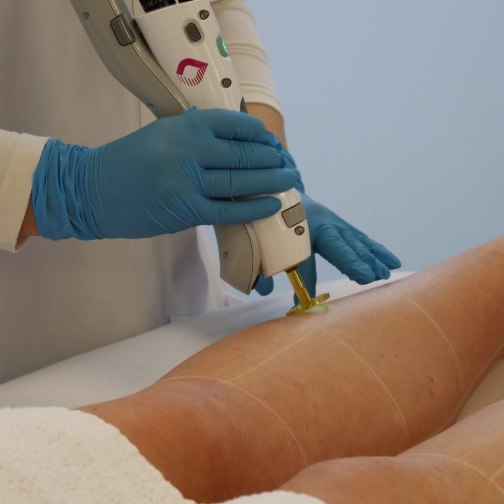Klant ontvangt laserbehandeling met Gentle Max Pro Plus bij Dermanova Clinic