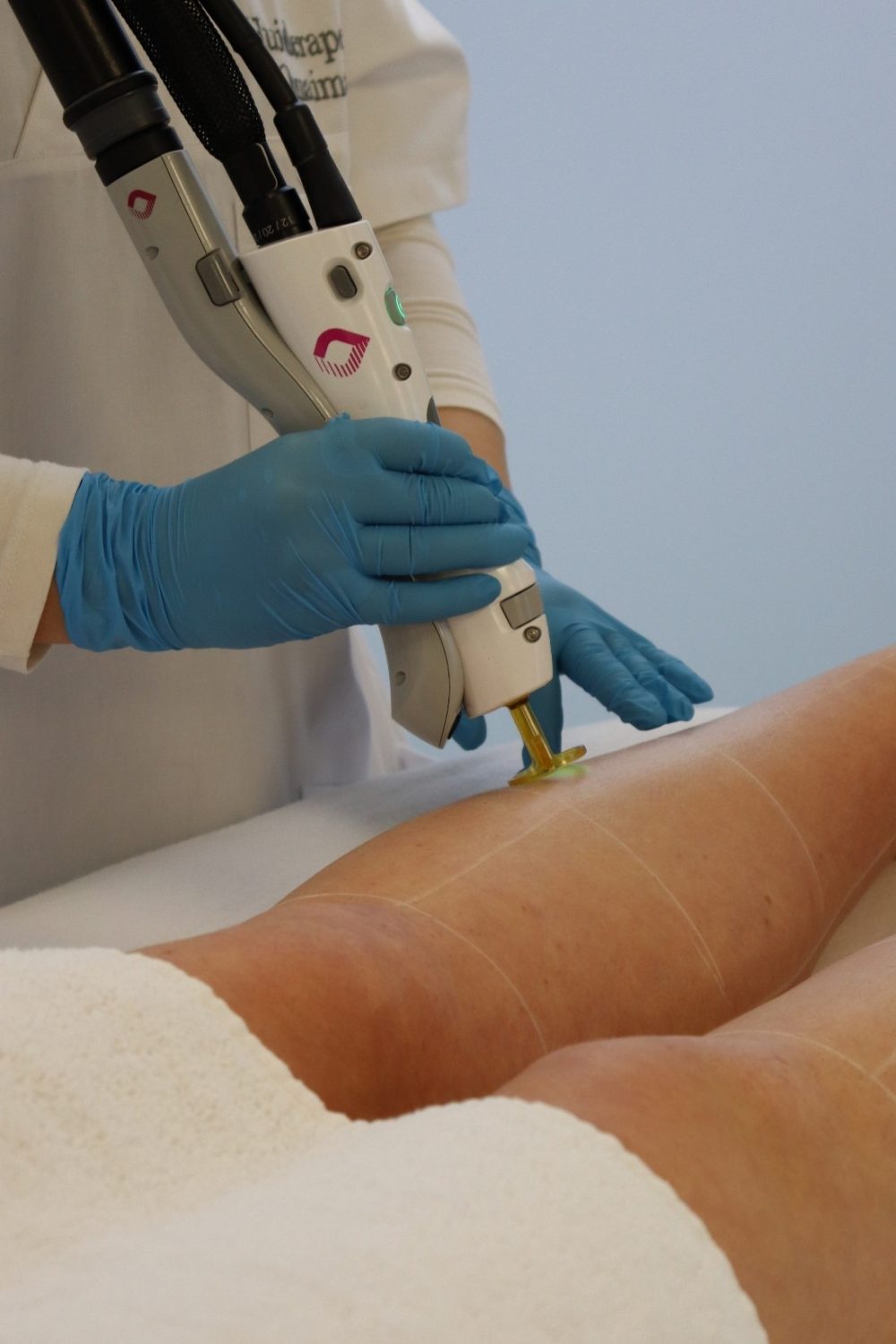 Klant ontvangt laserbehandeling met Gentle Max Pro Plus bij Dermanova Clinic